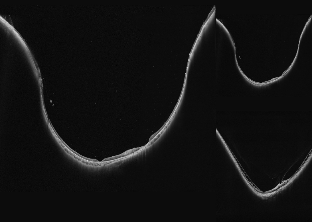 Ultra-widefield OCTA Montage