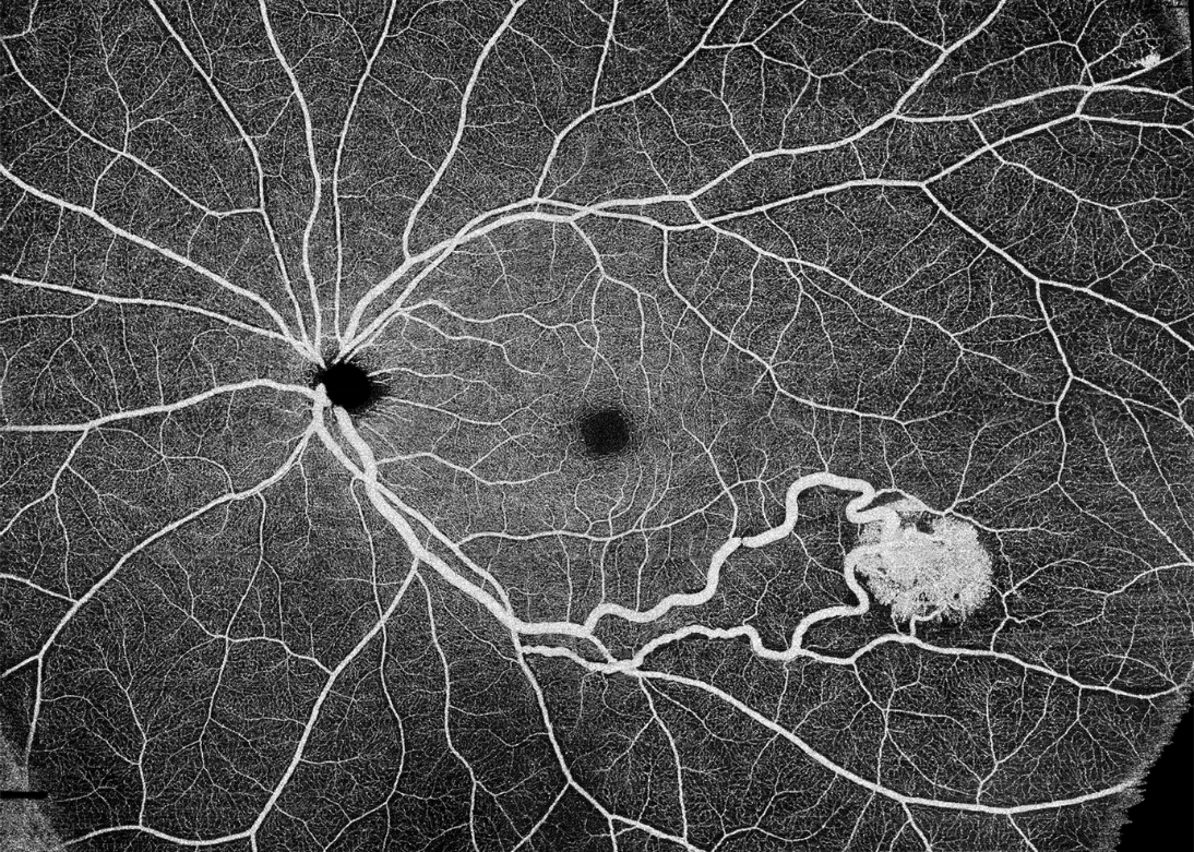 Retina OCT B-scan