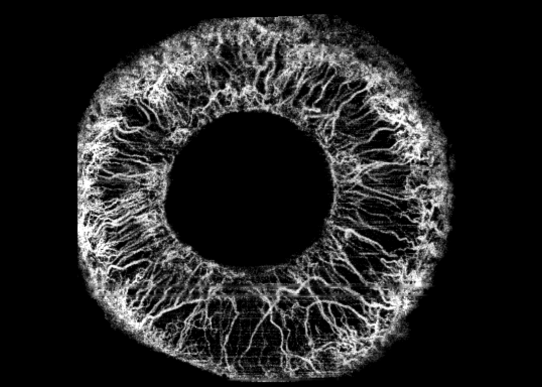 Glaucoma RNFL thickness map