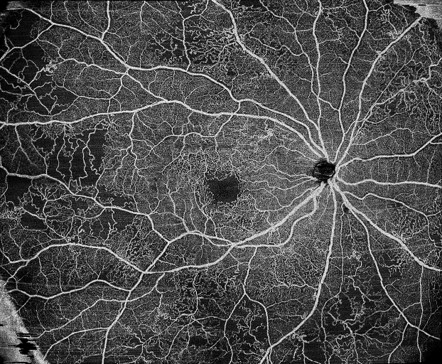 Widefield OCTA sample