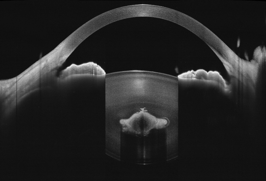 Anterior segment OCT sample