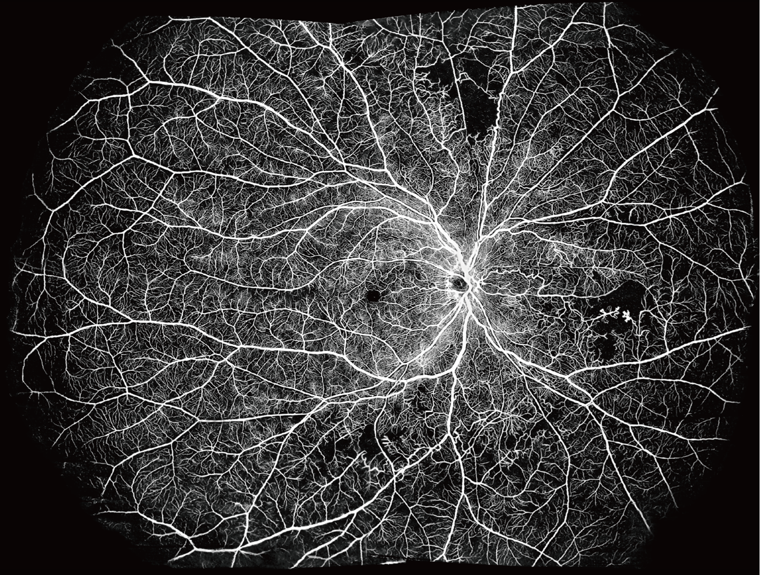 Ultra-widefield OCTA sample