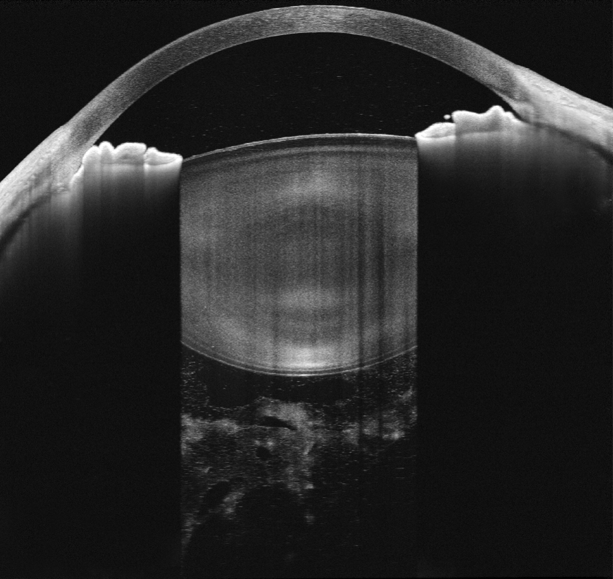 Anterior segment OCT sample