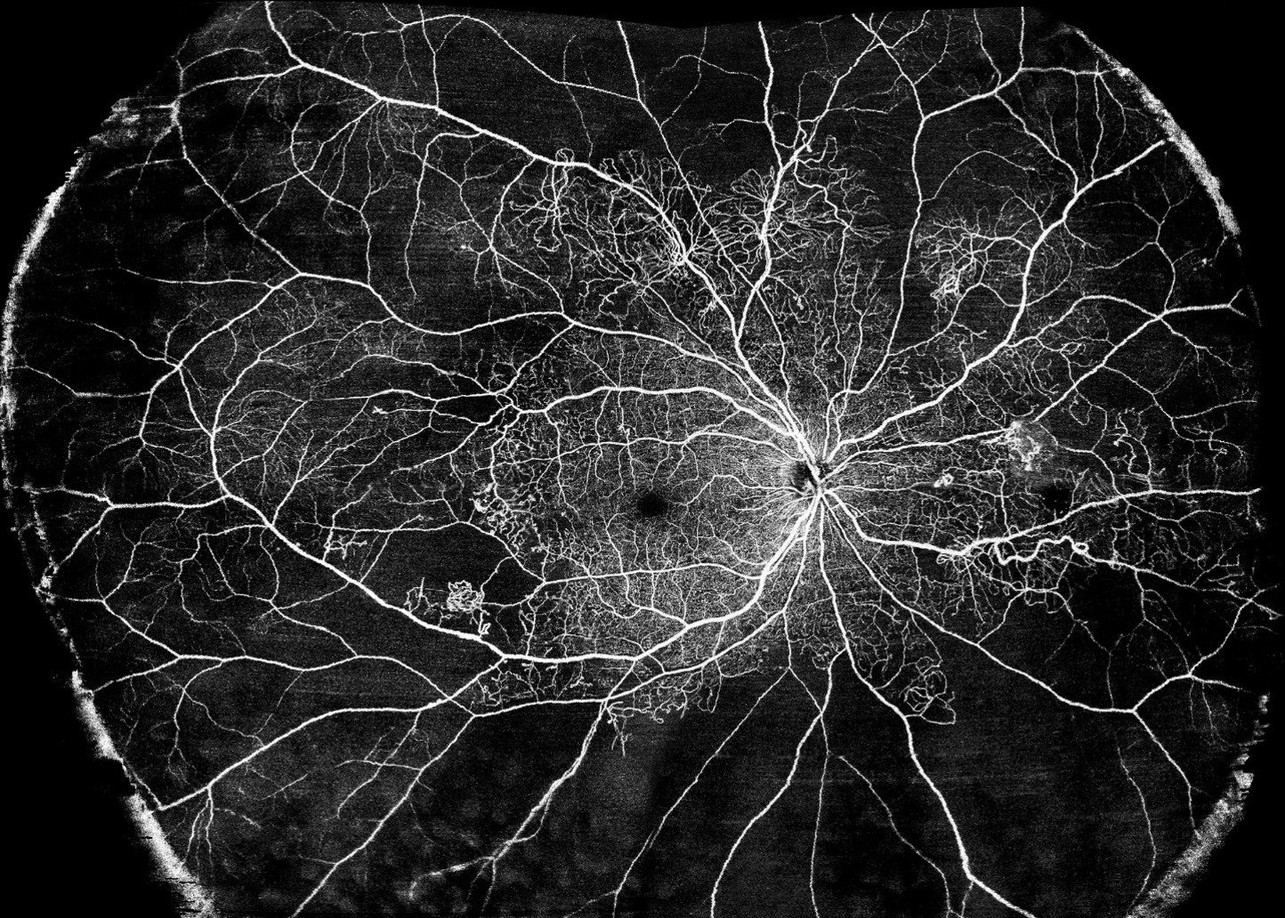 Widefield OCTA montage sample